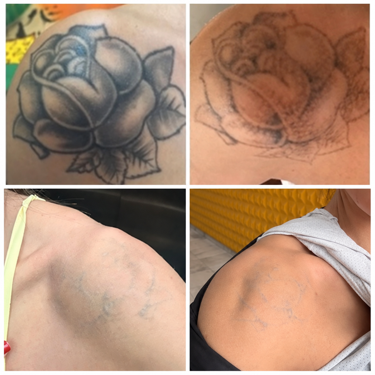 Progressão real do clareamento de tatuagem ao longo dos meses